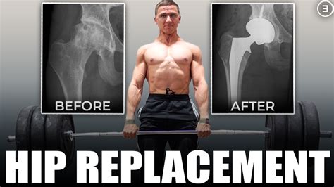 New Hip.